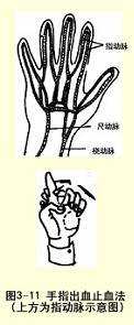  手指出血止血法