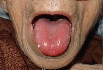 舌头上有红点怎么办
